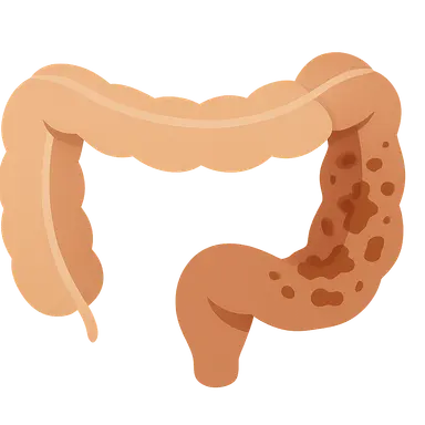 Necrotizing Enterocolitis