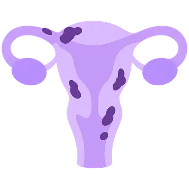 Endometriosis