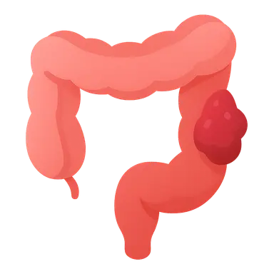 Cancer risk and surveillance in IBD