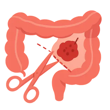 Colorectal cancer resection principles