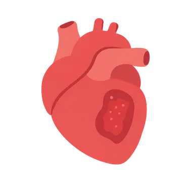 Infective endocarditis