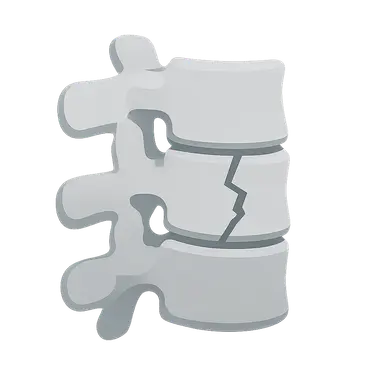 Spinal fracture management