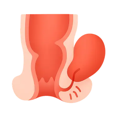 Anorectal Abscess and Fistula