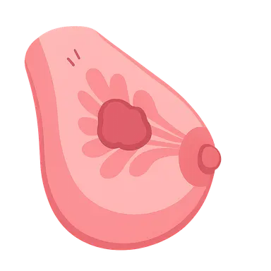 Benign Breast Diseases