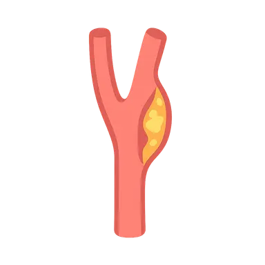 Carotid Artery Disease