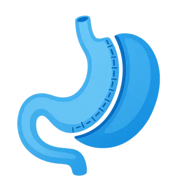 Sleeve Gastrectomy