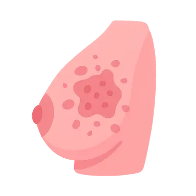 Inflammatory breast cancer