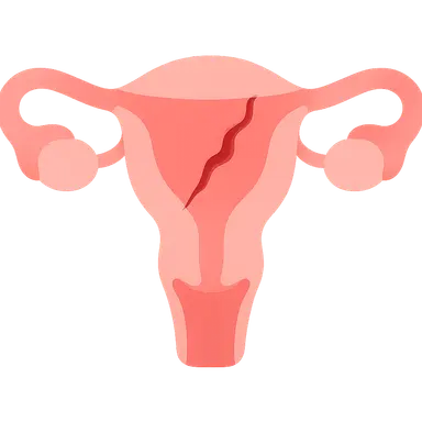Uterine rupture