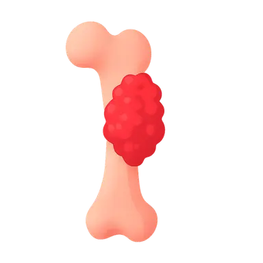 Bone Sarcomas
