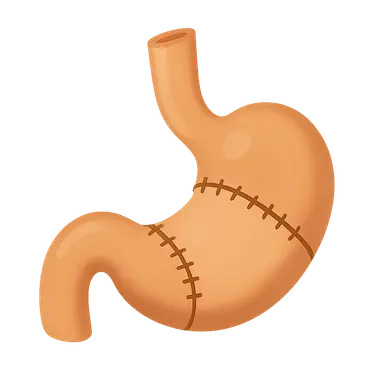 Esophageal surgery procedures