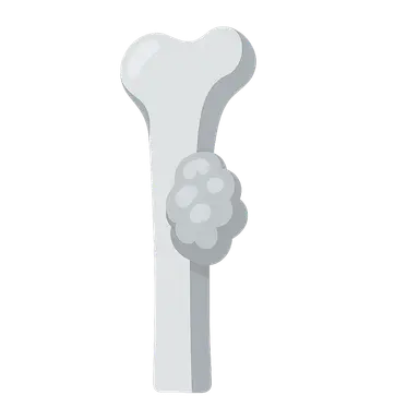 Benign Bone Tumors