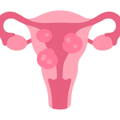 Uterine Fibroids