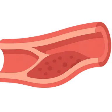 Atherosclerosis