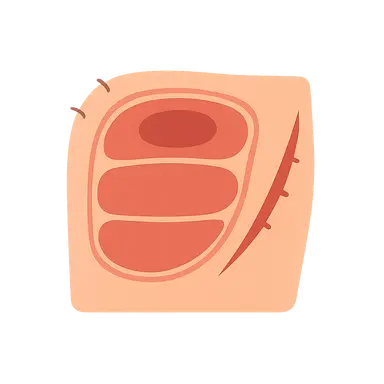 Compartment syndrome diagnosis and fasciotomy