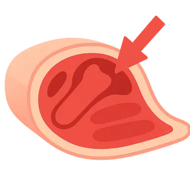 Compartment syndrome pathophysiology