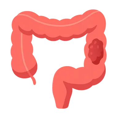 Colorectal Cancer