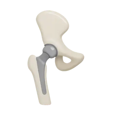 Joint replacement basics (hip