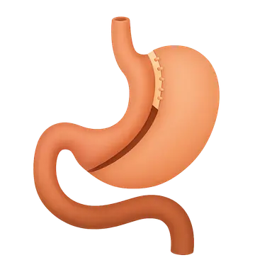 Malabsorptive Procedures