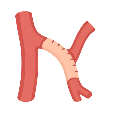 Bypass grafting techniques and materials