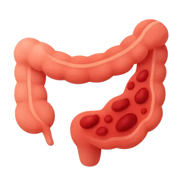 Ulcerative colitis pathophysiology