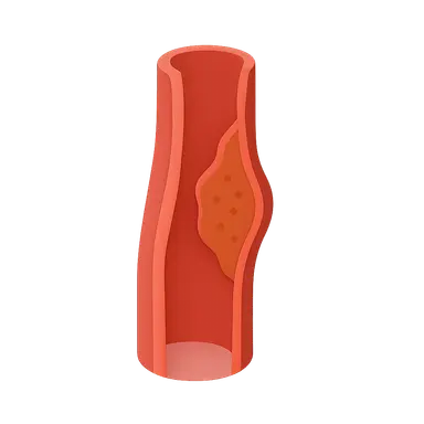 Atherosclerotic Disease