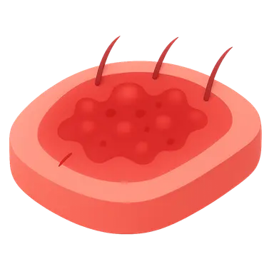 Acute and Chronic Inflammation
