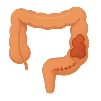 Inflammatory bowel disease surgical management