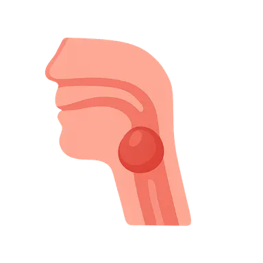Retropharyngeal Abscess