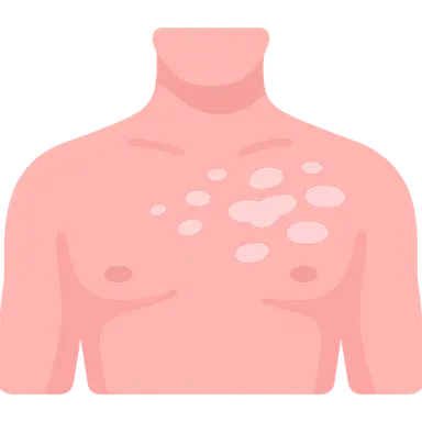 Pityriasis Alba