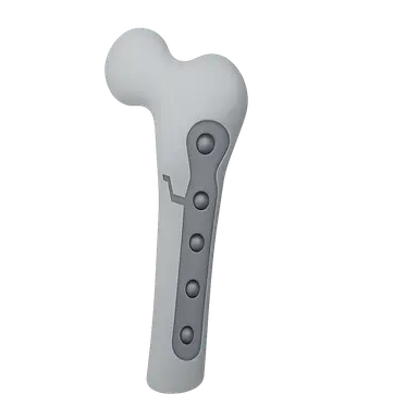 Principles of Internal Fixation