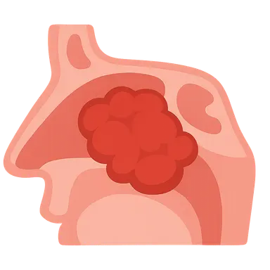 Tumors of the Nose and Paranasal Sinuses