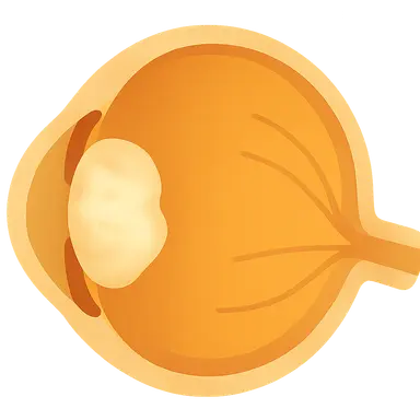 Drug-Induced Cataracts