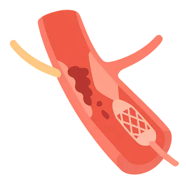 Reperfusion strategies (fibrinolysis vs PCI)