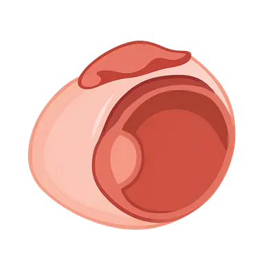 Complications of Refractive Surgery