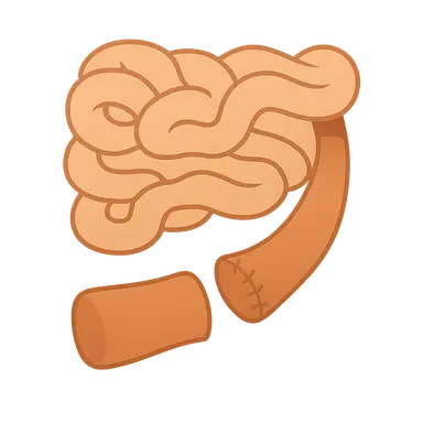 Small bowel resection and anastomosis