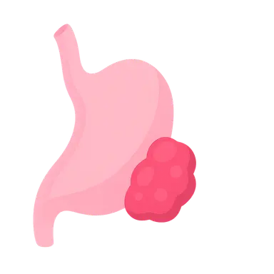 Salivary Gland Tumors