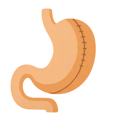 Bariatric surgery procedures and complications