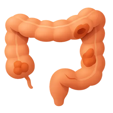 IBD-related complications