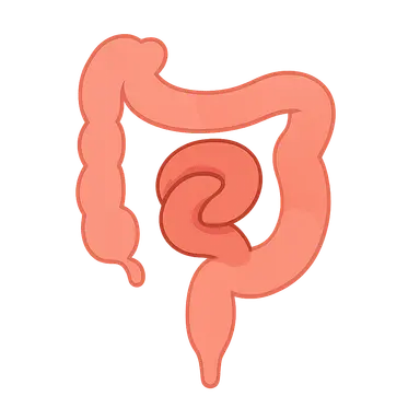 Malrotation and Volvulus