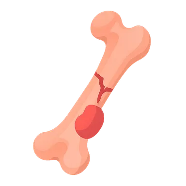 Fracture Complications