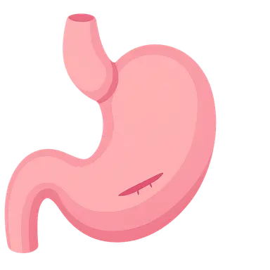Pyloric stenosis diagnosis and pyloromyotomy
