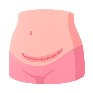 Recovery After Cesarean Delivery