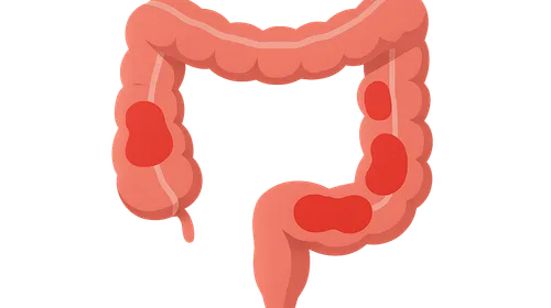 Inflammatory bowel disease