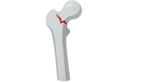 Neck of femur fracture