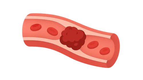 Venous thromboembolism