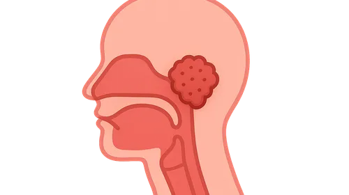 Nasopharyngeal Carcinoma