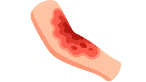 Burns assessment and management