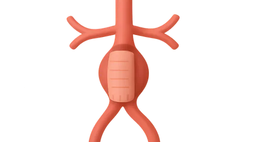 Abdominal aortic aneurysm repair