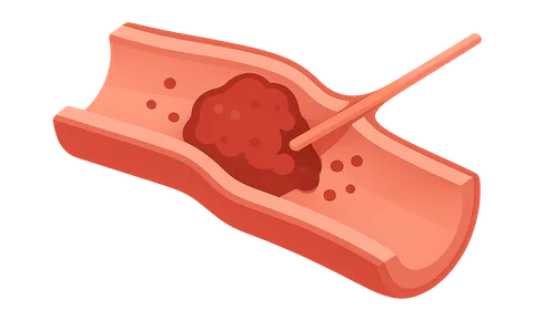 Thrombolysis and Thrombectomy