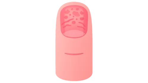 Nail Psoriasis and Other Inflammatory Nail Disorders